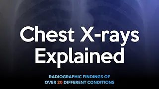 Chest X-rays Explained