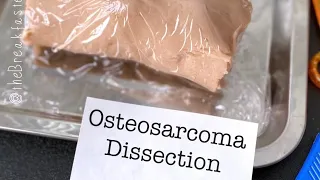 Playdough Surgery 🔪🦵🏼- Osteosarcoma Dissection
