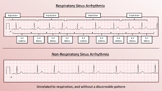 Advanced EKGs - Sinus Node Dysfunction