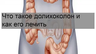 Что такое долихоколон и как его лечить