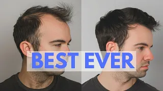 TOP 10 Hair Loss Treatments - Ranked by New Hair Growth!