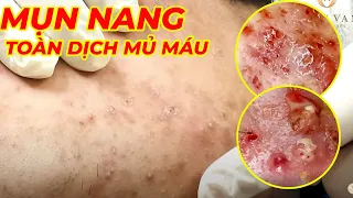 Điều trị mụn bọc, mụn nang với kỹ thuật lấy mụn độc quyền tại Hiền Vân Spa | Acne Treatment| 698