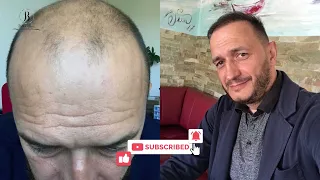 hair transplant before and after / результат пересадки волос