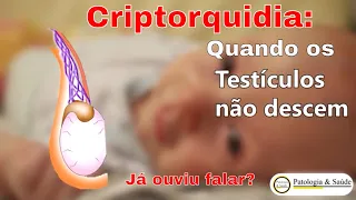 Você sabe o que é criptorquidia ou testículo não descido?