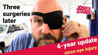 4-year eye update - after three surgeries