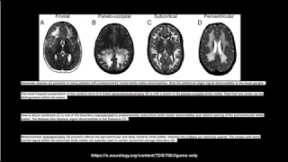 Myelination milestones -Approach