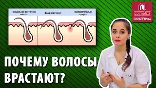 Почему волосы врастают? Профилактика вросших волос после шугаринга. Как избавиться от вросших волос?