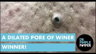 A Dilated Pore of Winer Winner!!