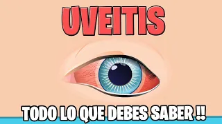 UVEITIS: Que es ? causas sintomas TRATAMIENTO | Oftalmologia