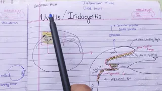 Uveitis /Iridocyclitis theory examination notes(( AK khurana))
