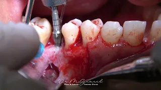 sinus lifting with simultaneous implant placement & Sticky bone grafting