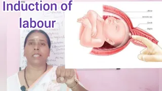 induction of labour/ labour/ medical induction/ surgical induction/ methods of induction of labour