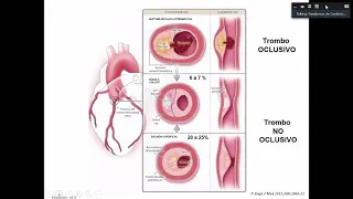 Síndrome coronario agudo sin elevación del segmento ST - Parte 1