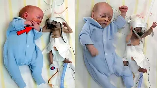 Mom Gives Birth to Twins Then Doctors Realize One of Them Isn't a Baby ...