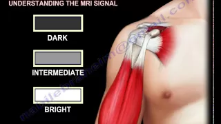 Rotator Cuff MRI - Everything You Need To Know - Dr. Nabil Ebraheim