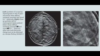 breast imaging(1)