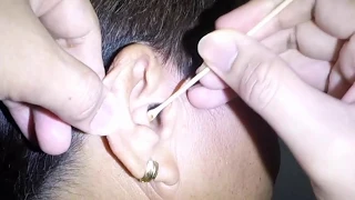 70-Years Flaky Earwax Removal!  Earwax Specialist