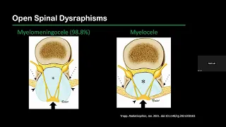 Spinal Dysraphisms -- Dr. Neil Lall -- 12.8.2022