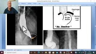 Esophageal disorders in Arabic 3 ( Achalasia of esophagus, part 2 ) , by Dr. Wahdan.