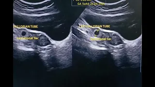 Ectopic Pregnancy in Tube, Tubal Pregnancy