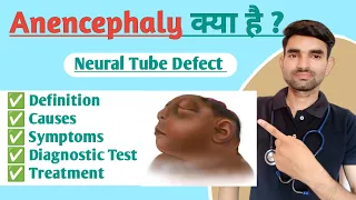 Anencephaly in Hindi | Causes, Symptoms And Treatment of Anencephaly