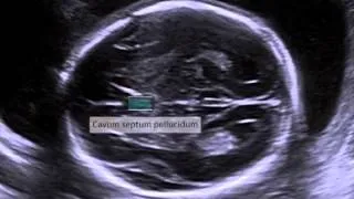 Transventricular View