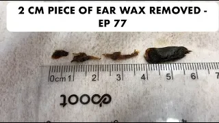 2 CM PIECE OF EAR WAX REMOVED - EP 77