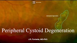 Peripheral Cystoid Degeneration. Peripheral Retinal Degenerations.