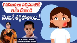 గవదబిళ్ళలు పోవాలంటే || How to Cure Mumps in Telugu || Mumps in Children || Treatment Range Hospital