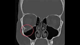 ORBITAL BLOW-OUT FRACTURE | CT SCAN BASICS | WHEN TO OPERATE ?