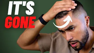 Why So Many Men Lose Their Hair In Their 20s