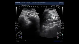 Ultrasound Video showing Multiple renal stones with ureteric stones.