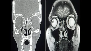 Difference between MRI and CT scan . 4 simple points.Dr.Ajinkya. H.Kedari.how to differentiate ?