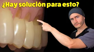 Desgastes en el cuello de los dientes | Causa y Solución | Abfracción Dental