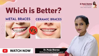 Ceramic Braces V/s Metal Braces - Which is better ? Orthodontic Treatment in Agra - Dr Pooja Sharma