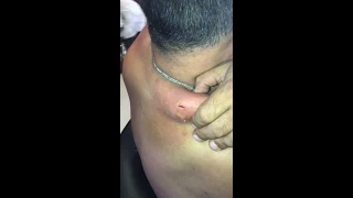 12 year old pimple cyst popped pus part 3 wait for it blood pus blackhead
