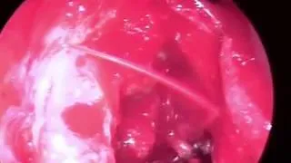 Angular Artery Bleeding during DCR
