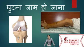 Stiff Knee Hindi घुटना जाम हो जाना. घुटना मुड़ नहीं रहा :आर्थ्रोस्कोपिक सर्जरी से इसका इलाज संभव है