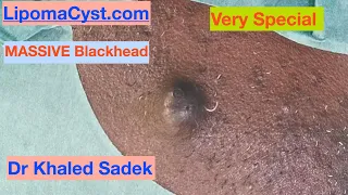 7 year Great Blackhead. Dr Khaled Sadek LipomaCyst.com