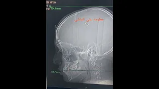 الاشعه المقطعيه علي الجيوب الانفيه بالصبغه CT PNS