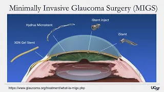 Understanding Glaucoma Diagnosis, Treatment, and Research on the Horizon