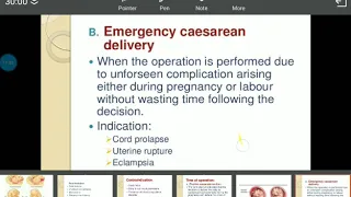 caesarean section