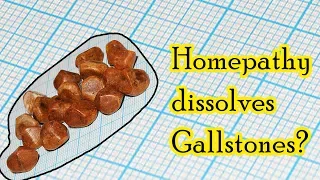 Can homeopathic medicine dissolve gallstones? - Dr. Sanjay Panicker