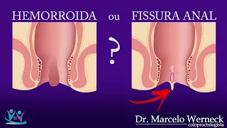 Como saber se é hemorroida ou fissura? | Dr. Marcelo Werneck