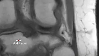 Lateral collateral ligament complex - normal anatomy