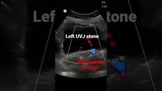 Left UVJ stone with twinkle artifact