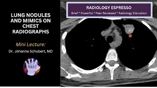 LUNG NODULES AND MIMICS ON CHEST RADIOGRAPHS: Mini Lecture, Dr. Johanna Schubert, MD