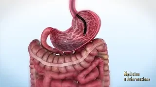 Sindrome dell'Intestino Irritabile: la rivoluzione diagnostica terapeutica