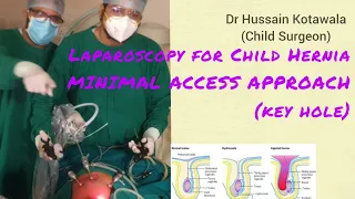 Laparoscopic Bilateral Inguinal Herniotomy in Child,Dr Hussain Kotawala