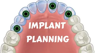 Dental Implant Lecture | Implant Treatment Planning | Key Implant position I Edentulous Arch